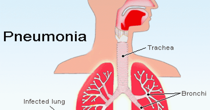 pneumonia.GIF